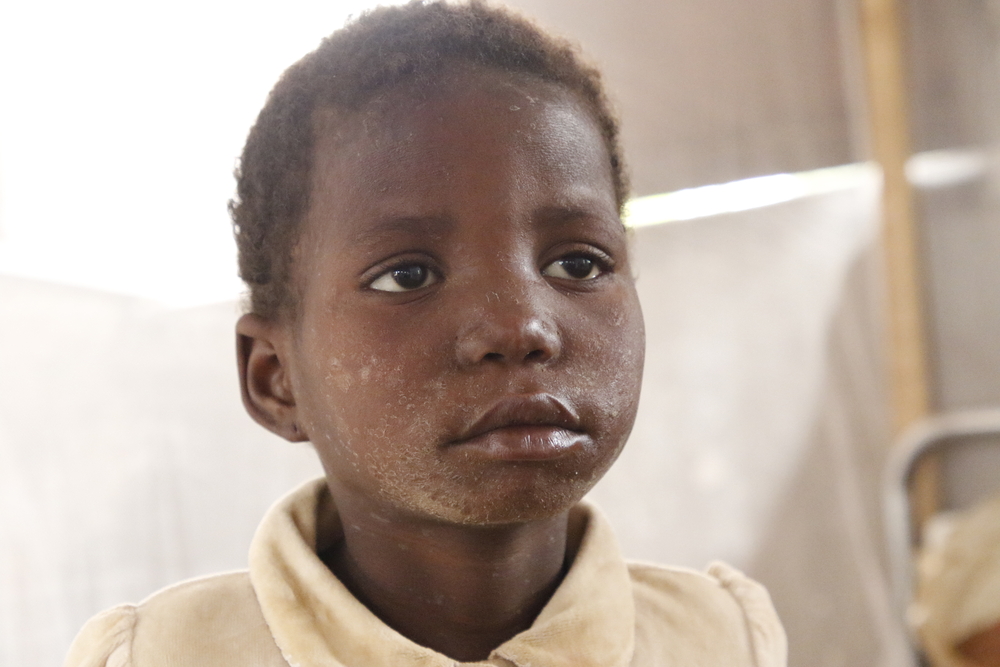 Obulu Solange, de 9 años, recibe tratamiento contra el sarampión en el hospital general de Bosobolo. Su madre Onie la trajo desde el pueblo de Dumbulu, a 50 km.  “Ahora ella está bien. Hay tantos casos de sarampión en nuestro pueblo
