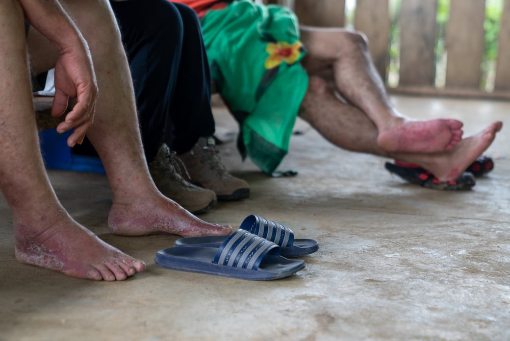 Una de las afecciones más comunes que presentan las personas tras atravesar el Darién es el daño en los pies. La humedad continua, el contacto con la arena y el barro y la gran cantidad de días de caminata hacen que los pies acaben inflamados y dañados. P
