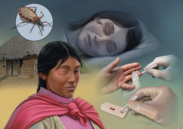 Enfermedad de chagas Enfermedad de chagas