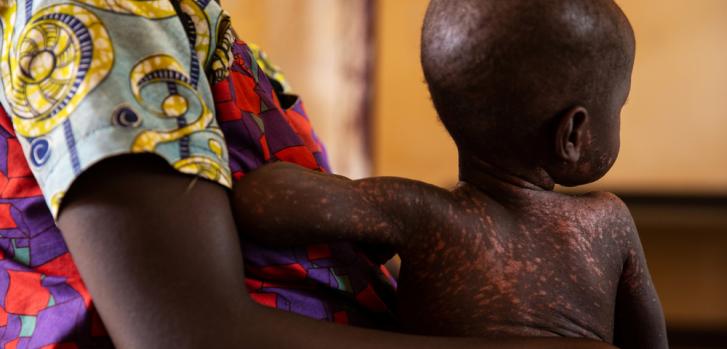 Foto ilustrativa. Nina junto a Ornella (de 2 años de edad) en el centro médico apoyado por MSF en el pueblo de Benzembe, a unas horas de Bossangoa, República Centroafricana.James Oatway