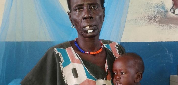 La pequeña Nyuruth Gain Nyandit, de 1 año, junto a su abuela, en nuestro centro de desnutrición terapéutica de Pibor, en Sudán del Sur. Cuando llegó a urgencias, a mediados de junio de 2016, pesaba solo seis kilos. Tres semanas después, cuando fue tomada esta foto, ya estaba fuera de peligro. ©Jean Soro/MSF