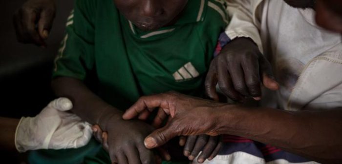 Nicsonne Dadjam, 13 años, recibiendo tratamiento en el hospital que apoyamos en Paoua, en el noroeste de República Centroafricana. Nicsonne fue mordido por una serpiente mientras trabajaba en los campos en su pueblo, a 2 horas en moto de Paoua.Alexis Huguet