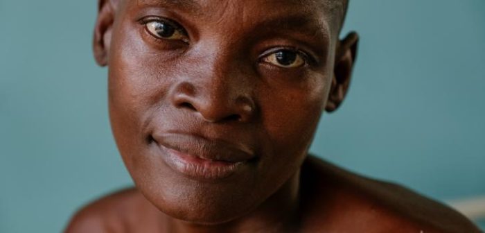 Grace, una paciente con VIH avanzado, en una sala del Hospital del Distrito de Nsanje. Además de estar en tratamiento antirretroviral, Grace ha estado en tratamiento contra la tuberculosis.Isabel Corthier/MSF
