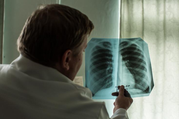 Radiografía paciente tuberculosis