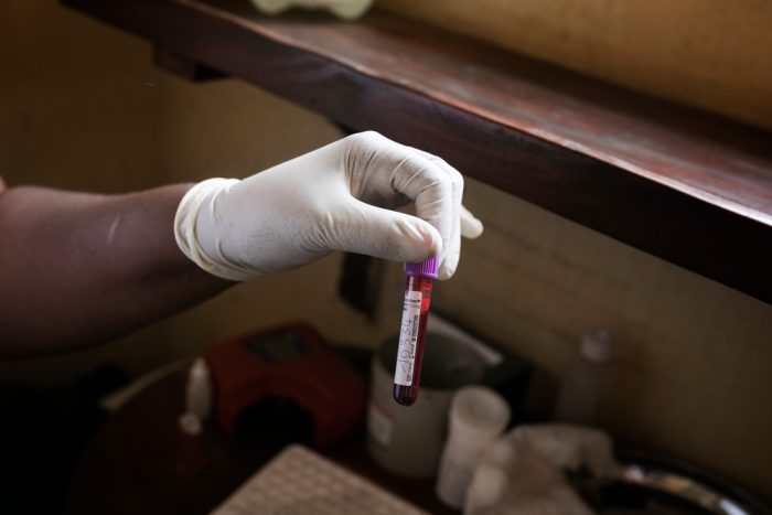 Test de sangre HIV.